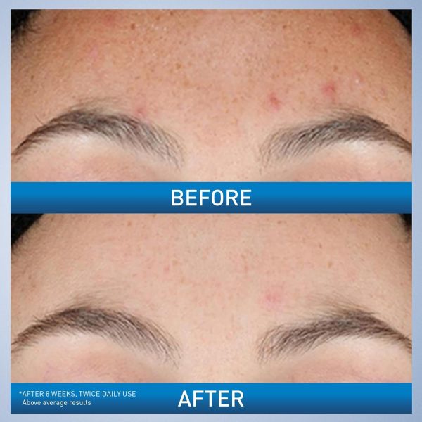 Cerave Resurfacing Retinol Serum For Post Acne Marks